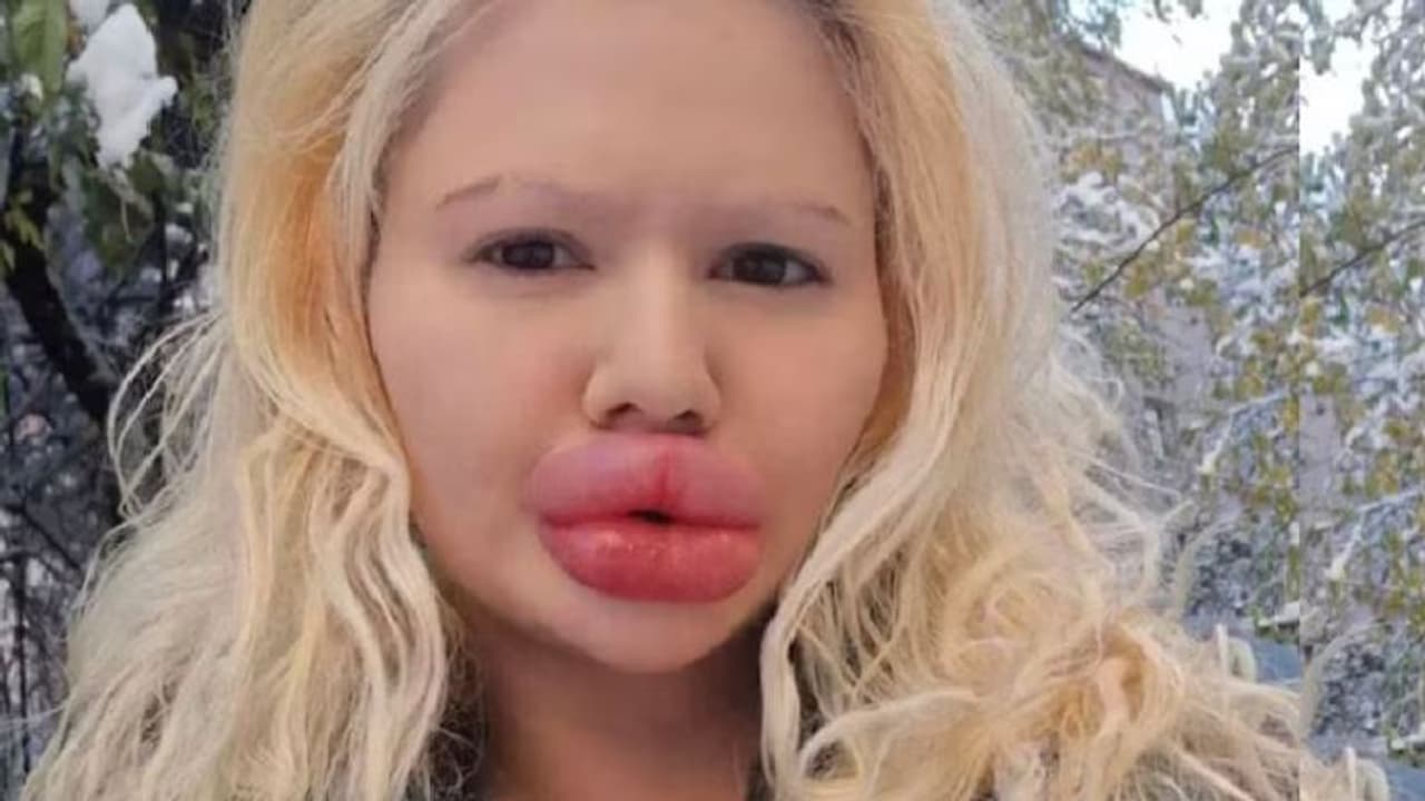 ದೊಡ್ಡ ತುಟಿಗಾಗಿ 4 ಬಾರಿ ಸರ್ಜರಿ ಮಾಡಿಸ್ಕೊಂಡ ಮಹಿಳೆ, ಆಮೇಲೆ ಆಗಿದ್ದೇ ಬೇರೆ! ದೊಡ್ಡ ತುಟಿಗಾಗಿ 4 ಬಾರಿ ಸರ್ಜರಿ ಮಾಡಿಸ್ಕೊಂಡ ಮಹಿಳೆ, ಆಮೇಲೆ ಆಗಿದ್ದೇ ಬೇರೆ!