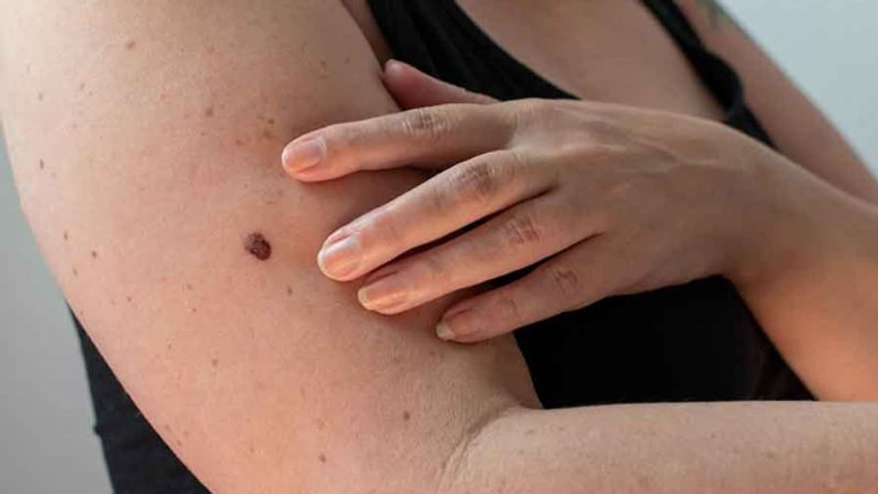 Health Tips: ശരീരം മുൻകൂട്ടി കാണിക്കുന്ന ഈ അഞ്ച് സൂചനകളെ അവഗണിക്കരുത്, ത്വക്കിലെ അര്‍ബുദമാകാം