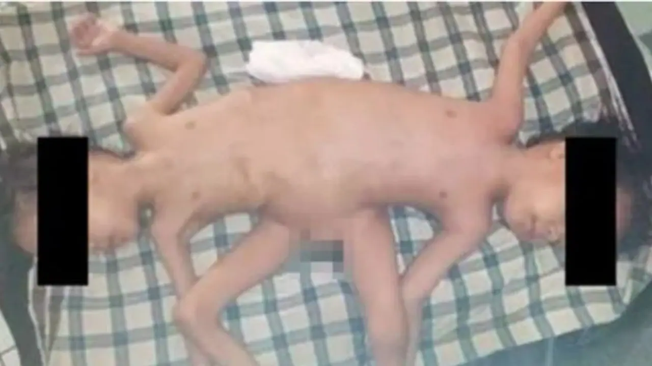1 in 2 million case: Rare Indonesian conjoined twins, born with 4 arms & 3 legs, undergo surgical correction