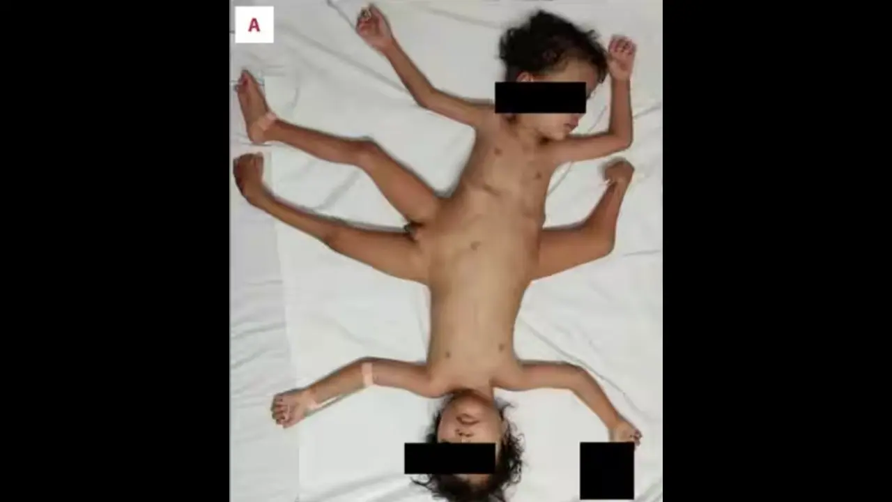 4 ಕೈ, 3 ಕಾಲಿನ ಜೊತೆ ಹುಟ್ಟಿದ್ದ ಸಯಾಮಿ ಅವಳಿಗಳಿಗೆ ನಡೀತು ಶಸ್ತ್ರಚಿಕಿತ್ಸೆ; ಈಗ ಹೇಗಿದ್ದಾರೆ? 4 ಕೈ, 3 ಕಾಲಿನ ಜೊತೆ ಹುಟ್ಟಿದ್ದ ಸಯಾಮಿ ಅವಳಿಗಳಿಗೆ ನಡೀತು ಶಸ್ತ್ರಚಿಕಿತ್ಸೆ; ಈಗ ಹೇಗಿದ್ದಾರೆ?