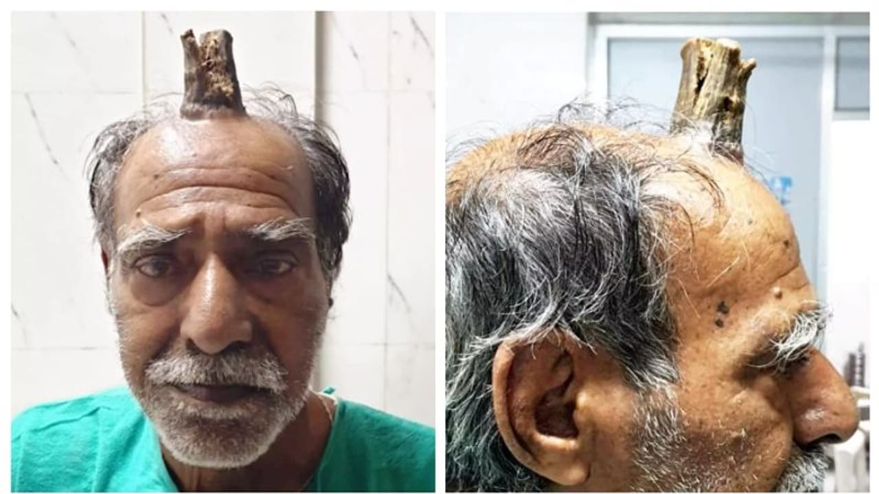 'ചെകുത്താന്റെ കൊമ്പു'മായി ജീവിച്ച ശ്യാം ലാല് യാദവ്; ഒടുവില് സംഭവിച്ചത് 'ചെകുത്താന്റെ കൊമ്പു'മായി ജീവിച്ച ശ്യാം ലാല് യാദവ്; ഒടുവില് സംഭവിച്ചത്