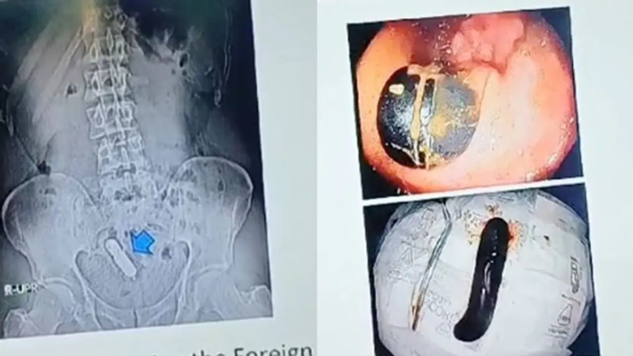 ಕಾಮತೃಷೆಗಾಗಿ ಗುದದ್ವಾರದಲ್ಲಿ ಸೆಕ್ಸ್ ಟಾಯ್ ತೂರಿಸಿಕೊಂಡಿದ್ದ 45ರ ವ್ಯಕ್ತಿ, ಸರ್ಜರಿ ಮೂಲಕ ಹೊರತೆಗೆದ ವೈದ್ಯರು! ಕಾಮತೃಷೆಗಾಗಿ ಗುದದ್ವಾರದಲ್ಲಿ ಸೆಕ್ಸ್ ಟಾಯ್ ತೂರಿಸಿಕೊಂಡಿದ್ದ 45ರ ವ್ಯಕ್ತಿ, ಸರ್ಜರಿ ಮೂಲಕ ಹೊರತೆಗೆದ ವೈದ್ಯರು!