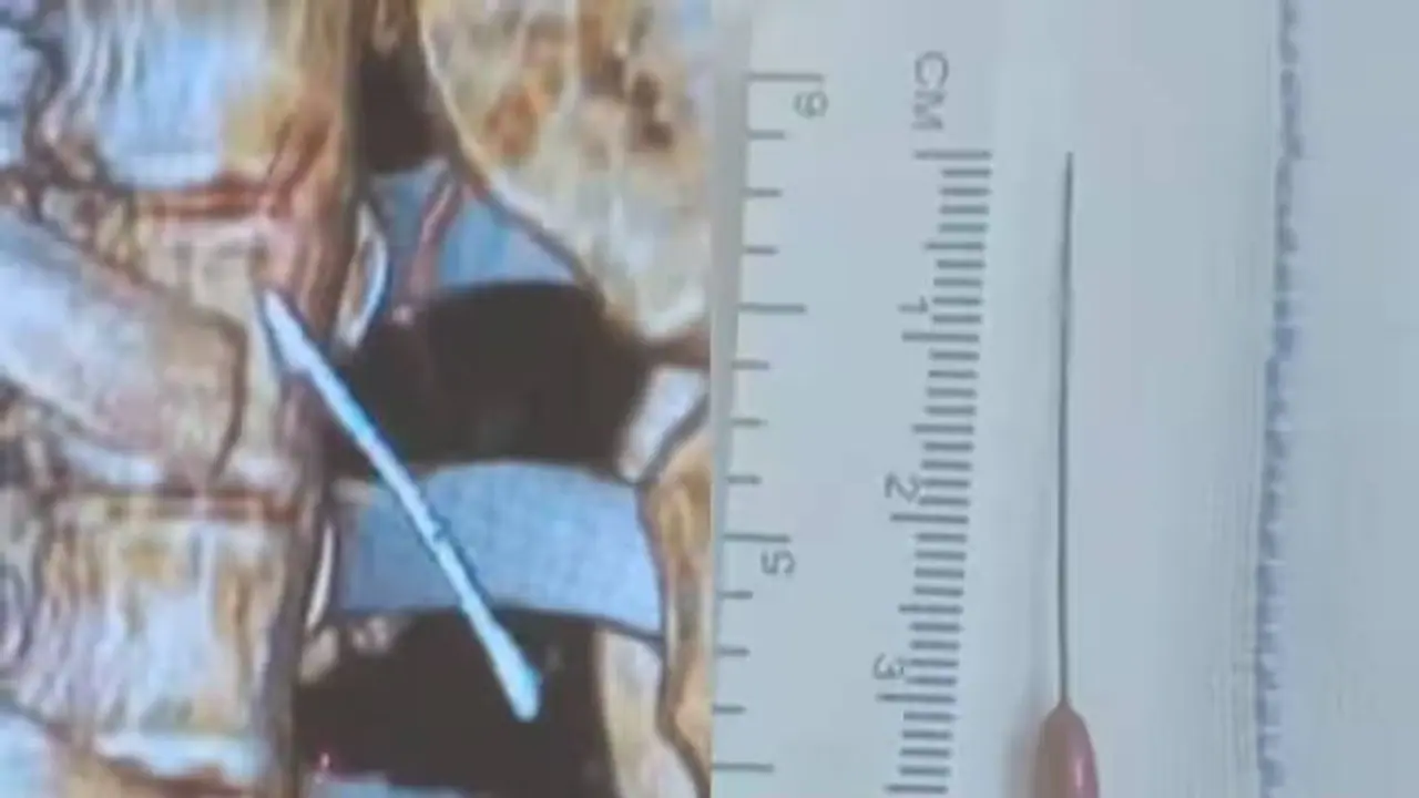 உடைமாற்றும் போது ஊசியை விழுங்கிய சிறுமி.. 3.5 நிமிடங்களில் அகற்றி தஞ்சை மருத்துவர்கள் சாதனை..