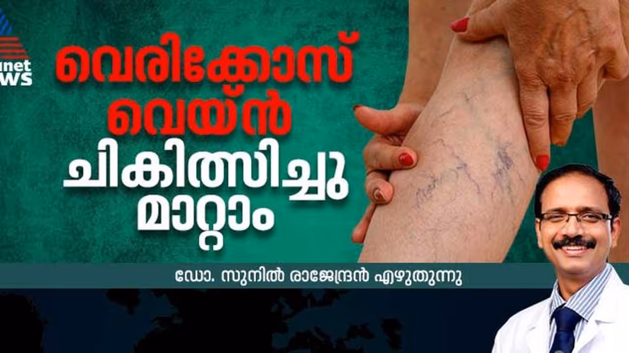 വെരിക്കോസ് വെയ്ന്‍ കൊണ്ടുനടക്കേണ്ട, ചികിത്സിച്ചു മാറ്റാം; ഡോക്ടര്‍ എഴുതുന്നു