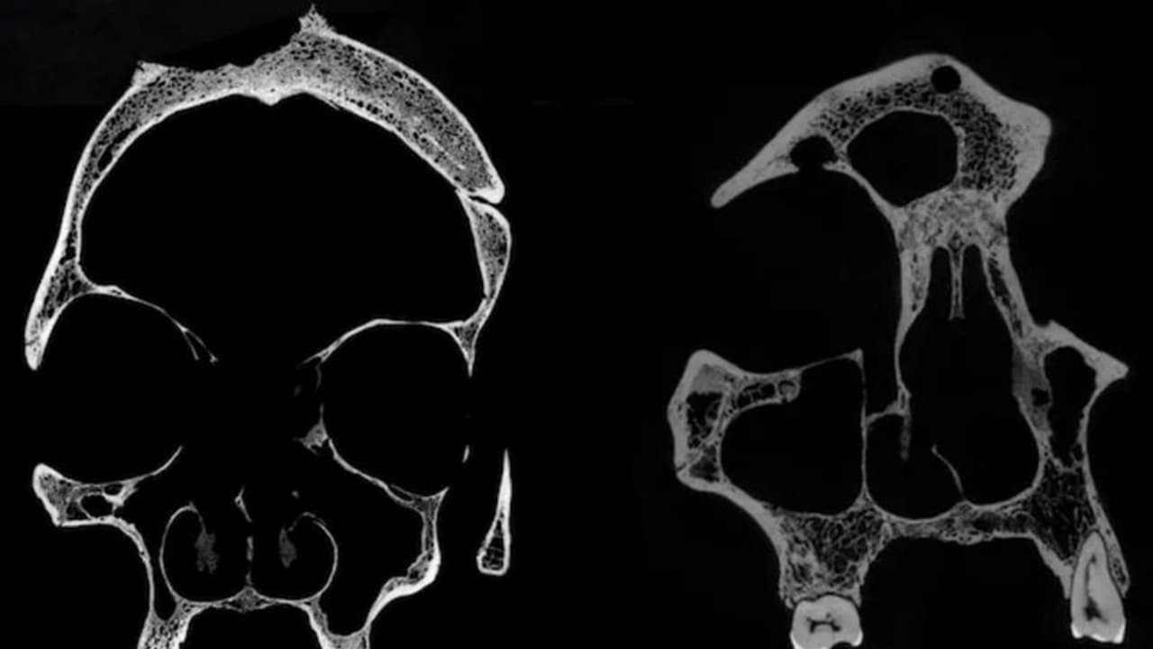 Cut marks on 4,000 year old skulls suggest Egyptians attempted cancer treatment; see pictures Cut marks on 4,000 year old skulls suggest Egyptians attempted cancer treatment; see pictures