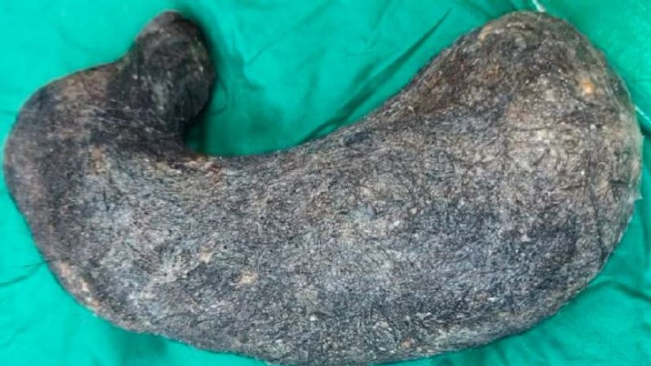 ಅಬ್ಬಬ್ಬಾ..ಮಹಿಳೆಯ ಹೊಟ್ಟೆಯೊಳಗಿತ್ತು ಬರೋಬ್ಬರಿ ಎರಡು ಕೆಜಿ ಕೂದಲು! ಅಬ್ಬಬ್ಬಾ..ಮಹಿಳೆಯ ಹೊಟ್ಟೆಯೊಳಗಿತ್ತು ಬರೋಬ್ಬರಿ ಎರಡು ಕೆಜಿ ಕೂದಲು!