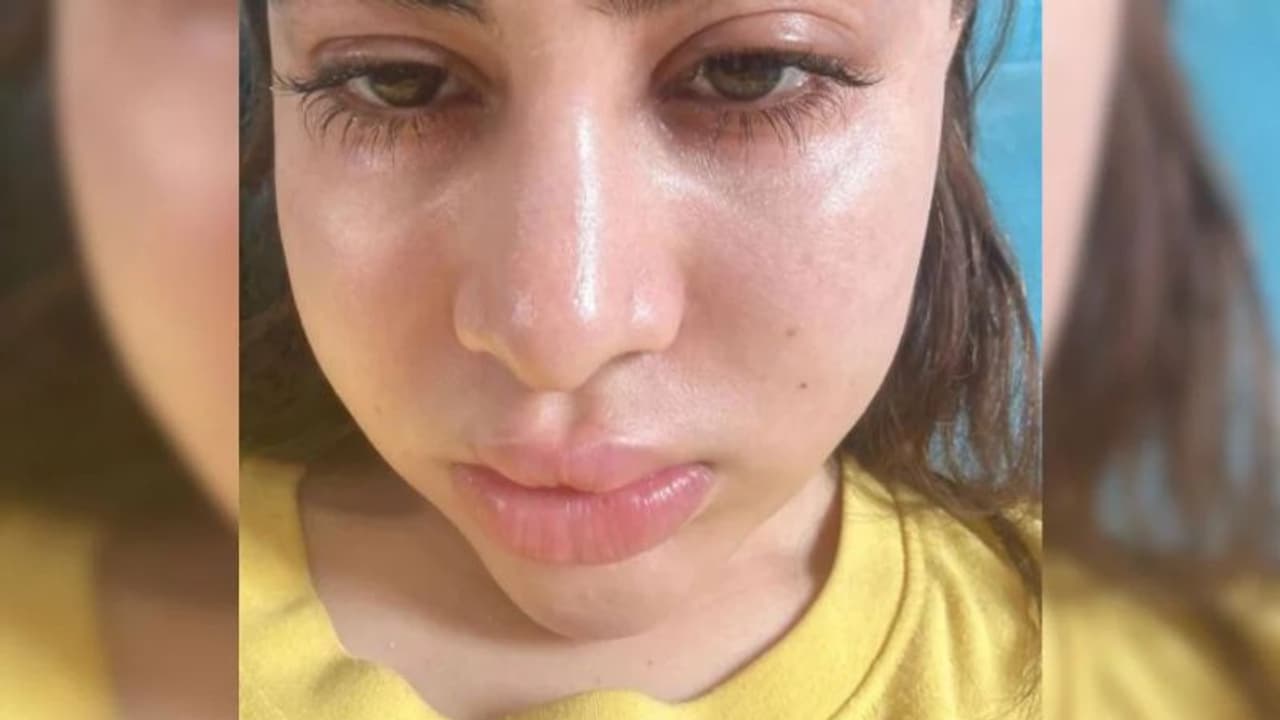 'ഇത് ഫില്ലേഴ്​സ് അല്ല അലര്‍ജിയാണ്'; വീര്‍ത്ത മുഖവുമായി ഉര്‍ഫി ജാവേദ്; പോസ്റ്റ് വൈറല്‍ 