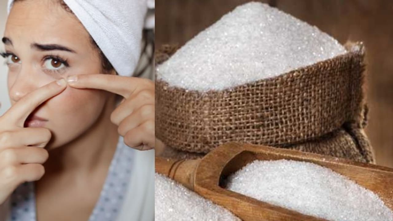 Health Tips: മുഖക്കുരുവിനെ തടയാന്‍ ഡയറ്റില്‍ നിന്നും ഒഴിവാക്കേണ്ട നാല് ഭക്ഷണങ്ങള്‍