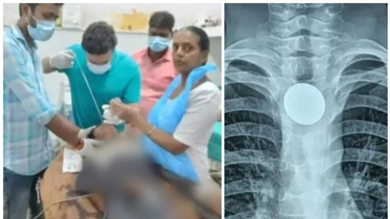 12 കാരൻ ആശുപത്രിയിലെത്തിയത് തൊണ്ട വേദനയുമായി; ശസ്ത്രക്രിയയിലൂടെ പുറത്തെടുത്തത് 7 കൊല്ലം മുമ്പ് വിഴുങ്ങിയ നാണയം 12 കാരൻ ആശുപത്രിയിലെത്തിയത് തൊണ്ട വേദനയുമായി; ശസ്ത്രക്രിയയിലൂടെ പുറത്തെടുത്തത് 7 കൊല്ലം മുമ്പ് വിഴുങ്ങിയ നാണയം