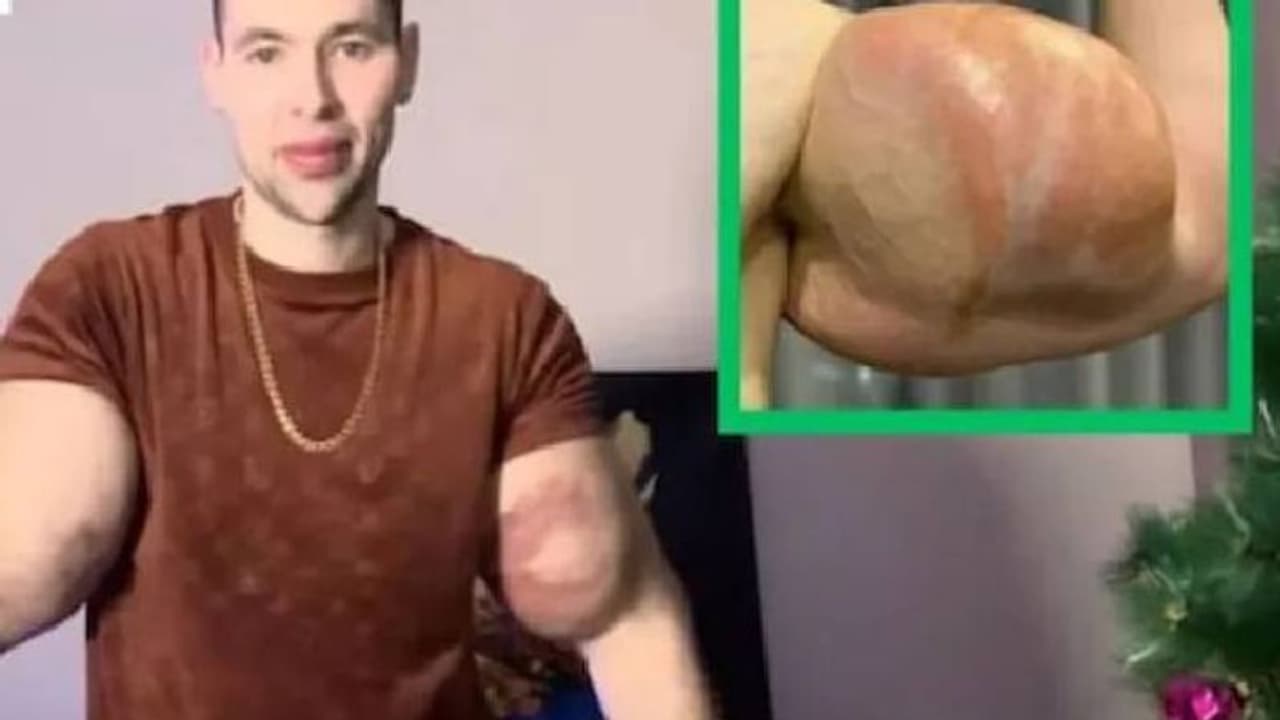 കൈകാലുകളിലെ മസിൽ പെരുപ്പിക്കാൻ 6 ലിറ്റർ വാസ്‍ലിൻ കുത്തിവച്ച് യുവാവ്