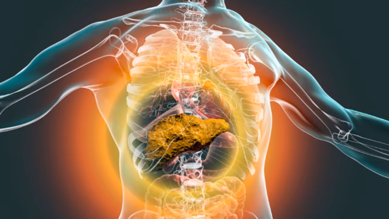 Health Tips: ലിവർ സിറോസിസ് രോഗികള്‍ ഡയറ്റില്‍ നിന്നും ഒഴിവാക്കേണ്ട ഭക്ഷണങ്ങള്‍ 