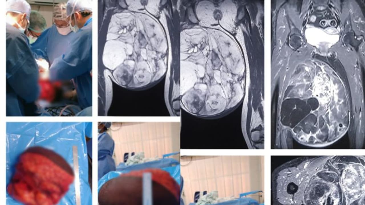 നടക്കാൻ പോലും പറ്റാതെ മെഡിക്കൽ കോളേജിൽ, 6 മണിക്കൂർ ശസ്ത്രക്രിയ, 61കാരിയുടെ തുടയിൽ വളർന്ന 10 കിലോ മുഴ നീക്കി