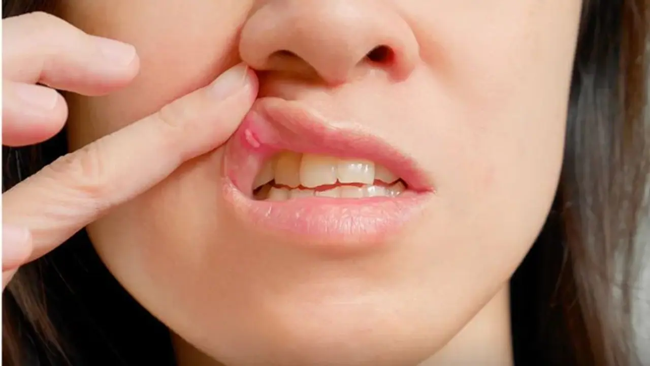 ഇടയ്ക്കിടെ വായ്പ്പുണ്ണ് വരാറുണ്ടോ? എങ്കില്‍, ഡയറ്റില്‍ നിന്ന് ഒഴിവാക്കണം ഈ ഭക്ഷണങ്ങള്‍