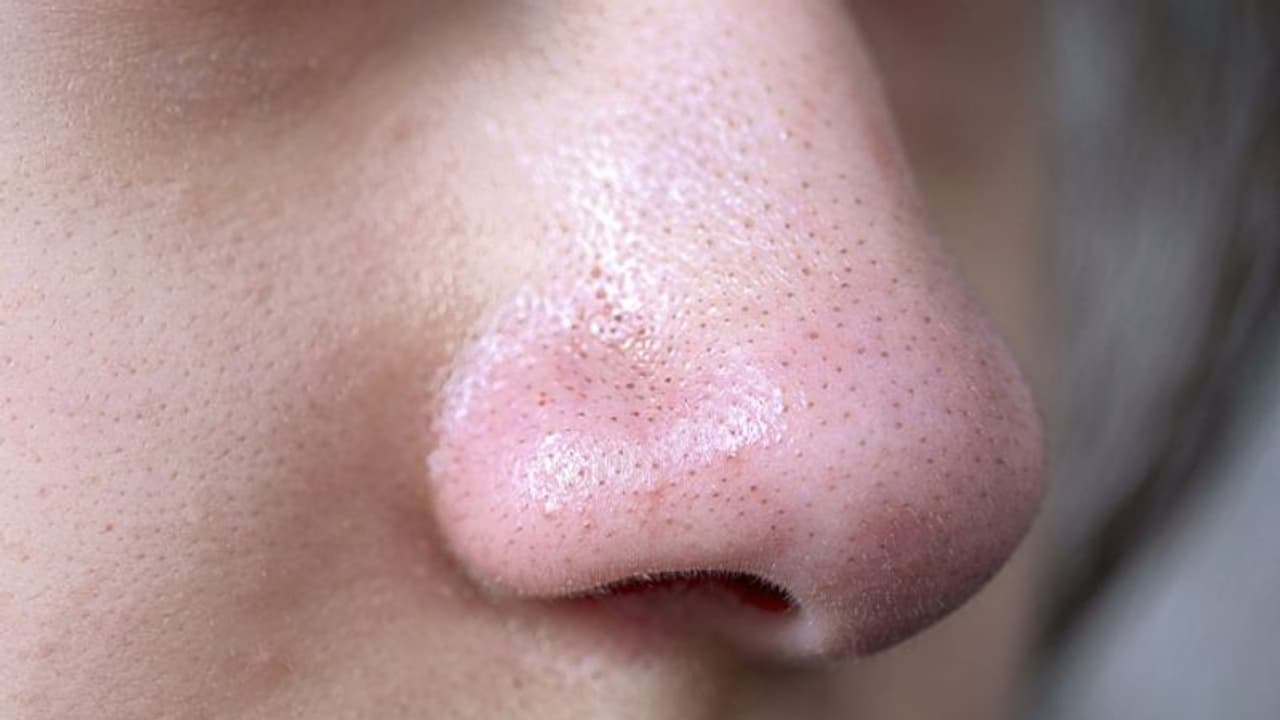 മുഖത്തെ ബ്ലാക്ക്ഹെഡ്സ് അകറ്റാന് വീട്ടില് പരീക്ഷിക്കാം ഈ പൊടിക്കൈകള്... മുഖത്തെ ബ്ലാക്ക്ഹെഡ്സ് അകറ്റാന് വീട്ടില് പരീക്ഷിക്കാം ഈ പൊടിക്കൈകള്...