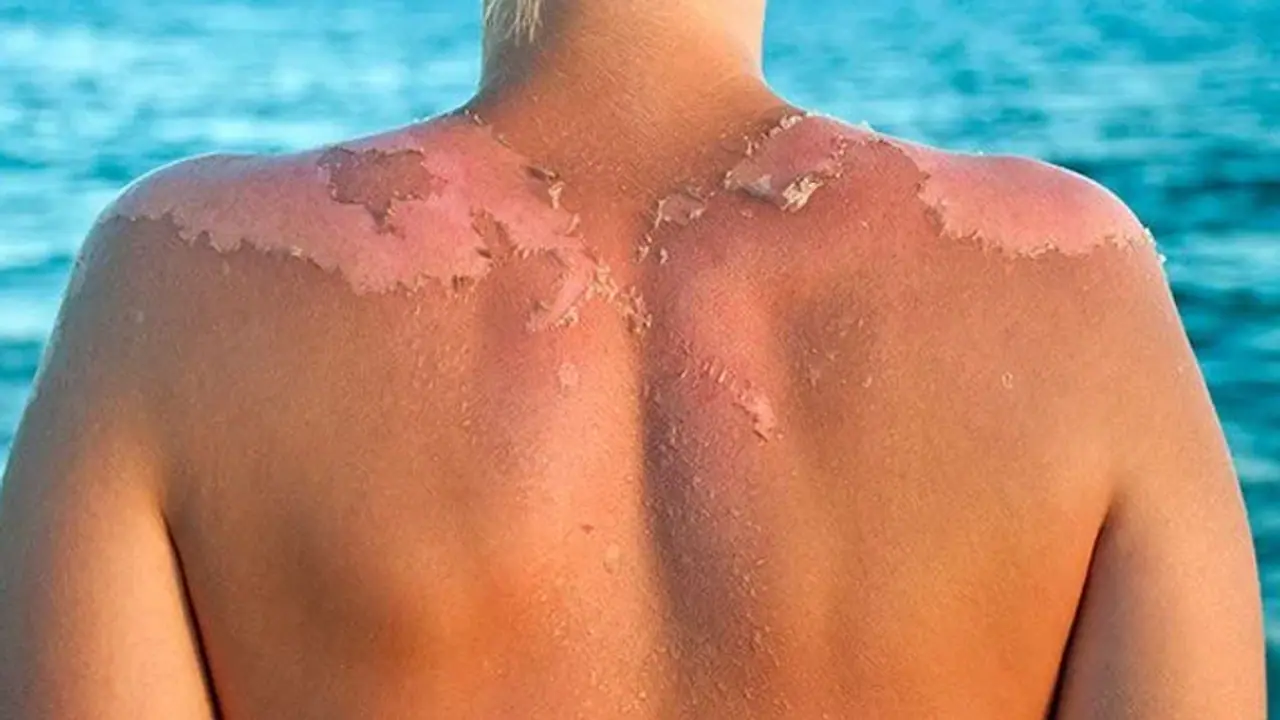 Sun Poisoning Sun Poisoning