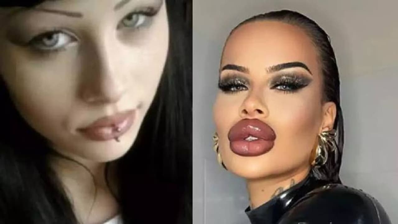 'നാശത്തിലേക്കാണ് നിന്റെ പോക്കെ'ന്ന് കൂട്ടുകാർ, 'വിചിത്രരൂപി'യെന്ന് കമന്റുകൾ; കോസ്മെറ്റിക് സർജറിക്കടിമയായ യുവതി 'നാശത്തിലേക്കാണ് നിന്റെ പോക്കെ'ന്ന് കൂട്ടുകാർ, 'വിചിത്രരൂപി'യെന്ന് കമന്റുകൾ; കോസ്മെറ്റിക് സർജറിക്കടിമയായ യുവതി