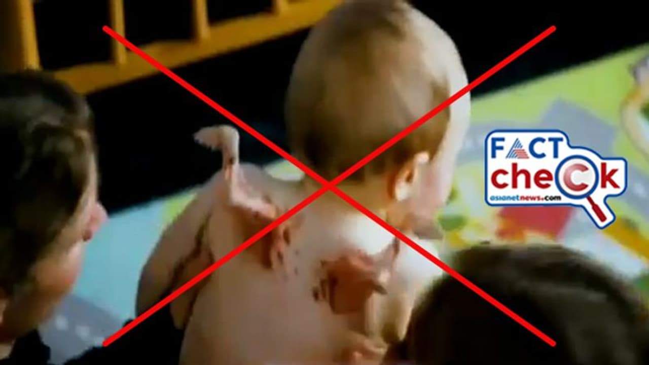 രണ്ട് ചിറകുകളുള്ള കുട്ടി, ലോക ചരിത്രത്തില്‍ ആദ്യത്തെ സംഭവമെന്നും പ്രചാരണം; എന്താണ് സത്യം?