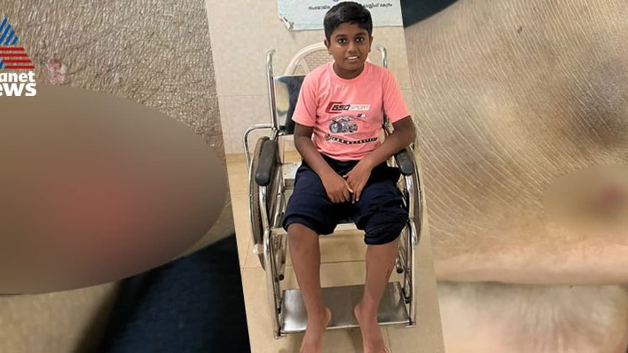 മദ്രസയിൽ പോയി വരവേ 12 വയസുകാരനെ തെരുവുനായ്ക്കൾ ഓടിച്ചിട്ട് കടിച്ചു, ഗുരുതര പരിക്ക്; രക്ഷകനായി ബൈക്ക് യാത്രികൻ മദ്രസയിൽ പോയി വരവേ 12 വയസുകാരനെ തെരുവുനായ്ക്കൾ ഓടിച്ചിട്ട് കടിച്ചു, ഗുരുതര പരിക്ക്; രക്ഷകനായി ബൈക്ക് യാത്രികൻ