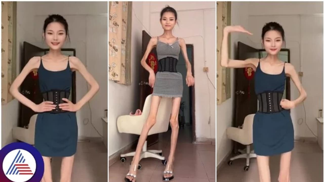 ತೂಕ ಇಳಿಸಿಕೊಳ್ಳಲು ಹೋಗಿ ಜೀವಂತ ಅಸ್ಥಿಪಂಜರವಾದ ಸುಂದರಿ; ಈಕೆ ದೇಹದಲ್ಲಿ ಹುಡುಕಿದರೂ ಪಾವ್ ಕೆಜಿ ಮಾಂಸವಿಲ್ಲ! ತೂಕ ಇಳಿಸಿಕೊಳ್ಳಲು ಹೋಗಿ ಜೀವಂತ ಅಸ್ಥಿಪಂಜರವಾದ ಸುಂದರಿ; ಈಕೆ ದೇಹದಲ್ಲಿ ಹುಡುಕಿದರೂ ಪಾವ್ ಕೆಜಿ ಮಾಂಸವಿಲ್ಲ!