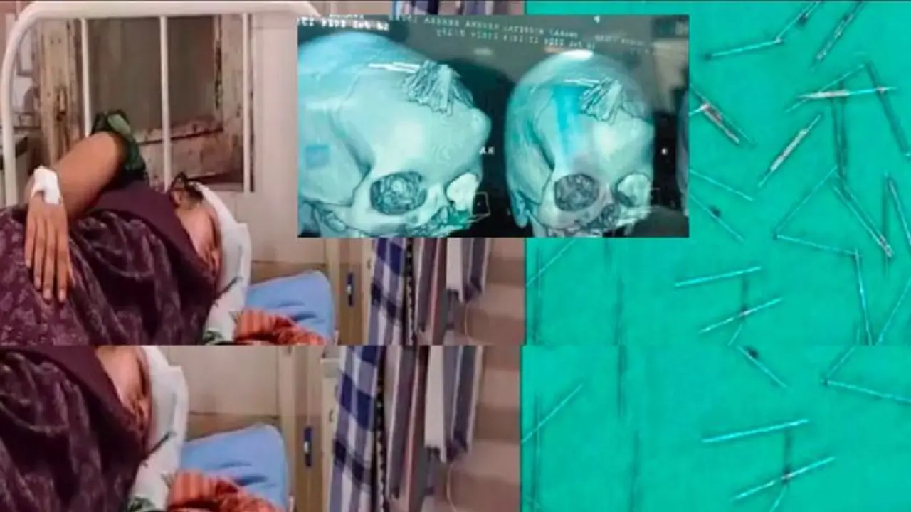  ಯುವತಿಯ ತಲೆ ಹೊಕ್ಕಿದ್ದ 70 ಸೂಜಿಗಳ ಶಸ್ತ್ರಚಿಕಿತ್ಸೆ ನಡೆಸಿ ಹೊರತೆಗೆದ ವೈದ್ಯರು