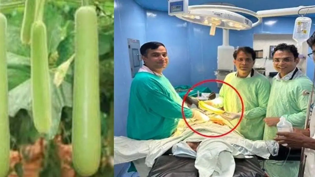 ರೈತನ ಗುದನಾಳ ಸೇರಿದ್ದ 16 ಇಂಚು ಉದ್ದದ ಸೋರೆಕಾಯಿ ಹೊರತೆಗೆದ ವೈದ್ಯರು