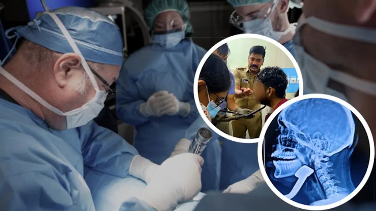 Pune teen critically injured as scooter stand penetrates neck in bus accident, docs successfully remove it