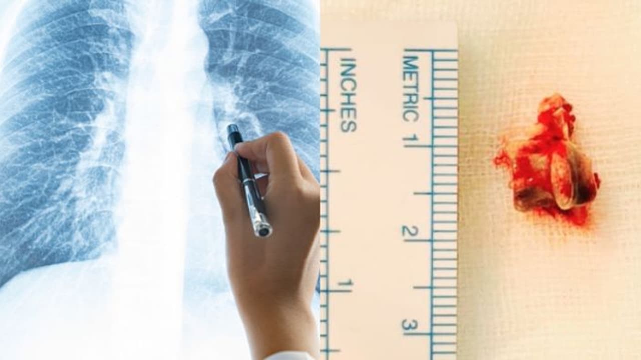 3 വർഷമായി മാറാത്ത ചുമ, 62കാരന്റെ ശ്വാസകോശത്തിൽ നിന്ന് കണ്ടെത്തിയത് കോഴിക്കറിയിലെ എല്ല് 