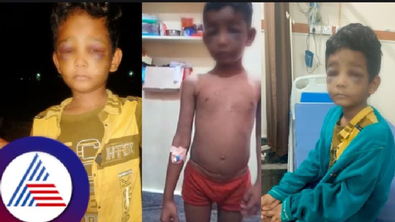 ಪೆನ್ನು ಕದ್ದಿದ್ದಕ್ಕೆ ಬಾಲಕನಿಗೆ ಮನಬಂದಂತೆ ಥಳಿಸಿದ ಗುರೂಜಿ! ಮಗನ ಸ್ಥಿತಿ ಕಂಡು ತಾಯಿ ಆಘಾತ! ಪೆನ್ನು ಕದ್ದಿದ್ದಕ್ಕೆ ಬಾಲಕನಿಗೆ ಮನಬಂದಂತೆ ಥಳಿಸಿದ ಗುರೂಜಿ! ಮಗನ ಸ್ಥಿತಿ ಕಂಡು ತಾಯಿ ಆಘಾತ!