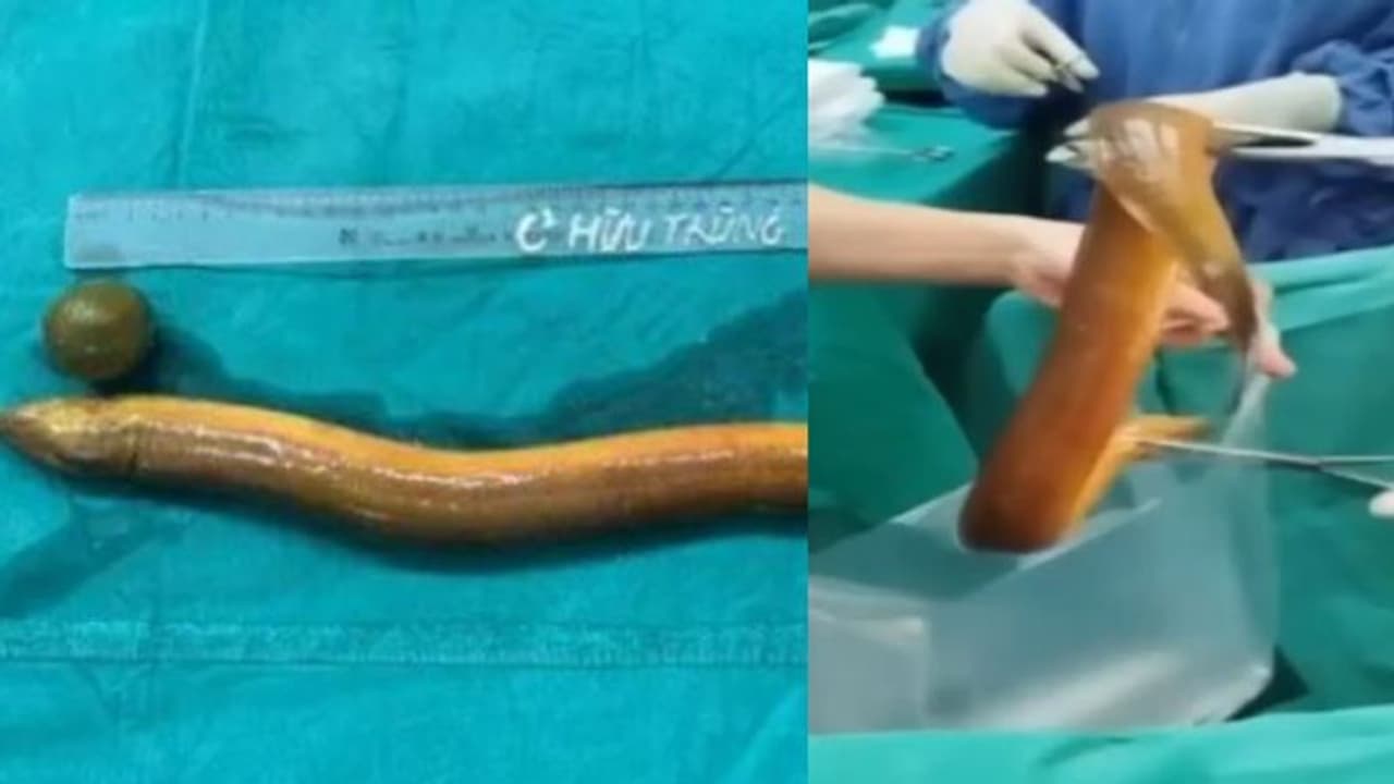 അതികഠിനമായ വയറുവേദന; ആശുപത്രിയിലെത്തിയ 31കാരനെ പരിശോധിച്ച ഡോക്ടർമാർക്ക് വരെ ആശ്ചര്യം, അകത്തുള്ളത് ജീവനുള്ള ഈൽ! അതികഠിനമായ വയറുവേദന; ആശുപത്രിയിലെത്തിയ 31കാരനെ പരിശോധിച്ച ഡോക്ടർമാർക്ക് വരെ ആശ്ചര്യം, അകത്തുള്ളത് ജീവനുള്ള ഈൽ!