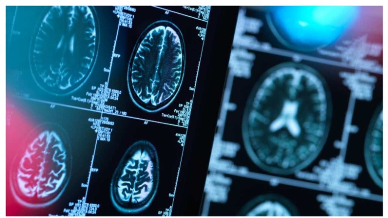 സാധാരണയെക്കാള് കൂടുതല് വേഗത്തിലുള്ള മസ്തിഷ്ക കോശങ്ങളുടെ വളര്ച്ച ഓട്ടിസത്തിന് കാരണമാകും ; പഠനം സാധാരണയെക്കാള് കൂടുതല് വേഗത്തിലുള്ള മസ്തിഷ്ക കോശങ്ങളുടെ വളര്ച്ച ഓട്ടിസത്തിന് കാരണമാകും ; പഠനം