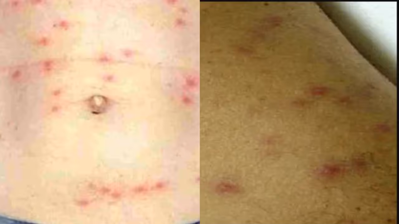 നീണ്ട പനി തലവേദനയും കണ്ണുചുവപ്പും, ചുവന്ന തടിപ്പോ ലക്ഷണങ്ങൾ, വേണം ഗൗരവമായ ശ്രദ്ധ, ജാഗ്രതയോടെ തടയാം ചെള്ള് പനി