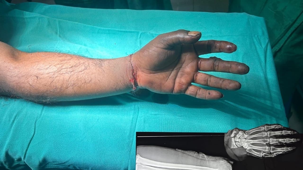 Shivamogga: ತುಂಡಾದ ಕೈಯನ್ನು ಯಶಸ್ವಿಯಾಗಿ ಮರುಜೋಡಿಸಿದ ‘ಸರ್ಜಿ’ ವೈದ್ಯರು: ಎರಡೂ ಕೈಗಳಿಗೆ ಮರುಜೀವ Shivamogga: ತುಂಡಾದ ಕೈಯನ್ನು ಯಶಸ್ವಿಯಾಗಿ ಮರುಜೋಡಿಸಿದ ‘ಸರ್ಜಿ’ ವೈದ್ಯರು: ಎರಡೂ ಕೈಗಳಿಗೆ ಮರುಜೀವ