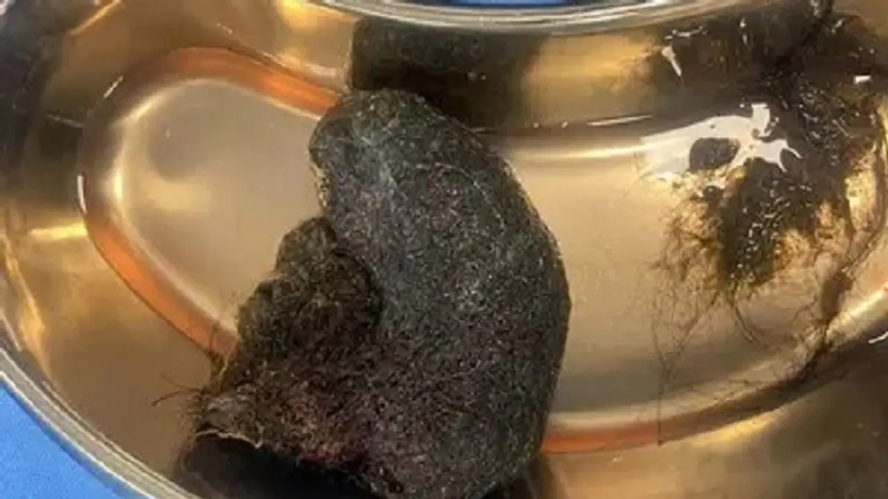 Bengaluru: ಎಂಟು ವರ್ಷದ ಬಾಲಕಿಯ ಹೊಟ್ಟೆಯಿಂದ ಕ್ರಿಕೆಟ್ ಚೆಂಡಿನ ಗಾತ್ರದ ಕೂದಲ ಬಾಲ್ ಹೊರತೆಗೆದ ವೈದ್ಯರು! Bengaluru: ಎಂಟು ವರ್ಷದ ಬಾಲಕಿಯ ಹೊಟ್ಟೆಯಿಂದ ಕ್ರಿಕೆಟ್ ಚೆಂಡಿನ ಗಾತ್ರದ ಕೂದಲ ಬಾಲ್ ಹೊರತೆಗೆದ ವೈದ್ಯರು!