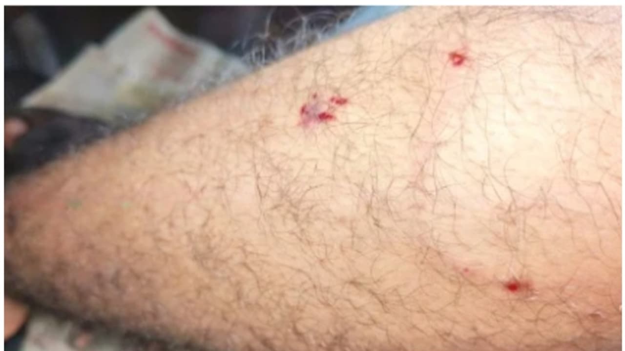 കൊയിലാണ്ടി ബസ് സ്റ്റാന്റില്‍ തെരുവ് നായ ആക്രമണം; വിദ്യാര്‍ത്ഥി ഉള്‍പ്പെടെ മൂന്ന് പേര്‍ക്ക് കടിയേറ്റു