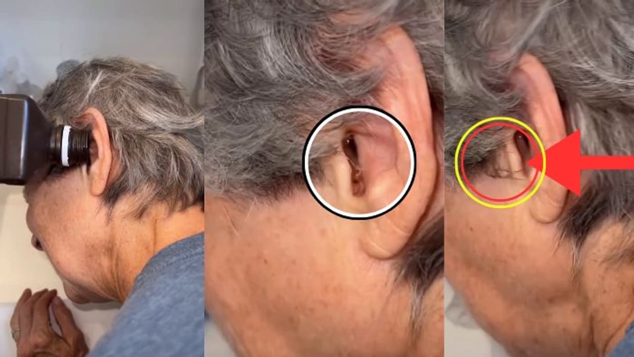 ಮಹಿಳೆಯ ಕಿವಿಯಿಂದ ಹೊರಬಂದ ಜೇಡ! ವೈರಲ್ ವಿಡಿಯೋ ನೋಡಿ