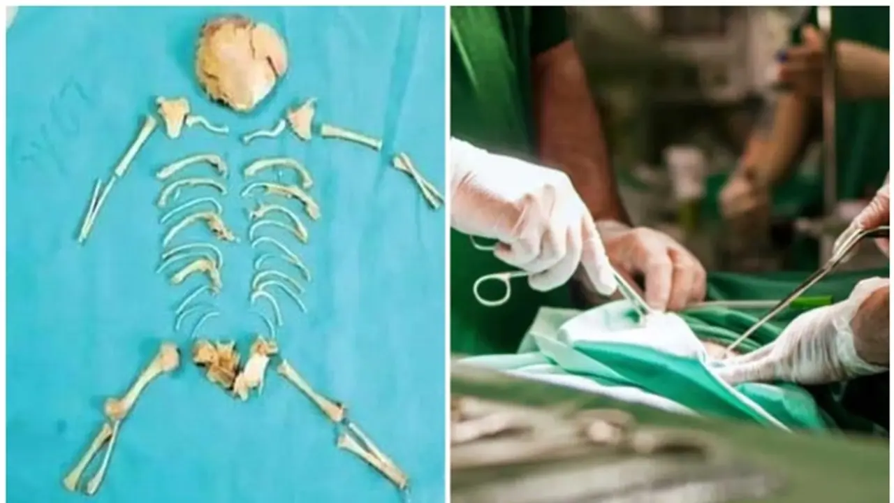 വയറ്റിൽ ആറ് മാസം പ്രായമുള്ള 'സ്റ്റോൺ ബേബി'; കടുത്ത വയറുവേദയുമായി എത്തിയ 27കാരിയിൽ കണ്ടെത്തിയത് അപൂർവ പ്രതിഭാസം വയറ്റിൽ ആറ് മാസം പ്രായമുള്ള 'സ്റ്റോൺ ബേബി'; കടുത്ത വയറുവേദയുമായി എത്തിയ 27കാരിയിൽ കണ്ടെത്തിയത് അപൂർവ പ്രതിഭാസം