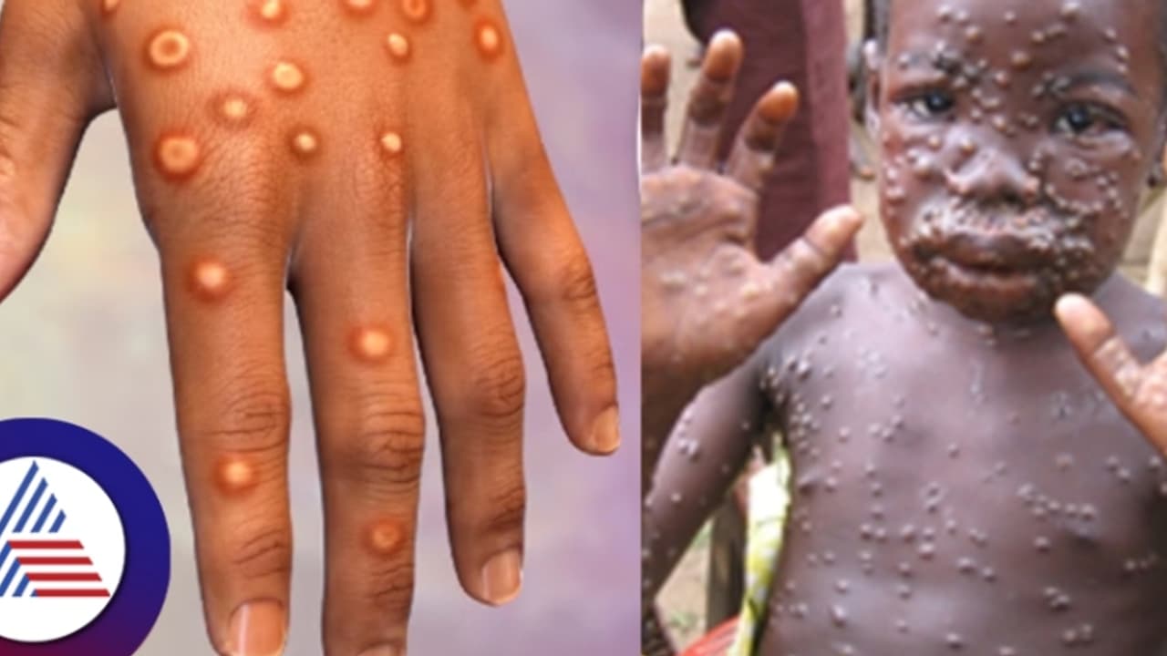 ಆಫ್ರಿಕಾದ 12 ದೇಶಗಳಲ್ಲಿ ಭಾರೀ ಅನಾಹುತ ಸೃಷ್ಟಿಸಿರುವ ಮಂಕಿಪಾಕ್ಸ್‌ ಭಾರತಕ್ಕೂ ಪ್ರವೇಶ?