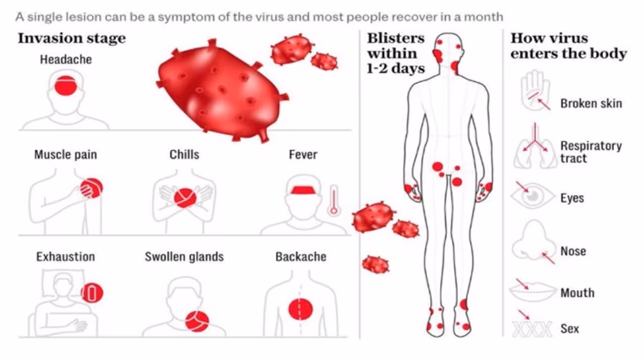 Mpox  और COVID 19 के बीच क्या है अंतर? जानें घातक बीमारी से सुरक्षित रहने के तरीके 