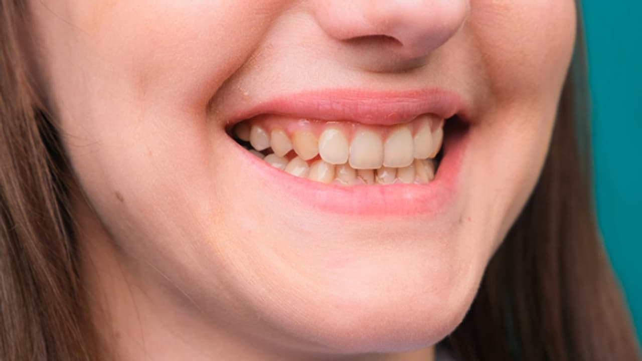 പല്ലുകളിലെ മഞ്ഞ നിറം മാറ്റാന് വീട്ടില് പരീക്ഷിക്കേണ്ട കാര്യങ്ങള് പല്ലുകളിലെ മഞ്ഞ നിറം മാറ്റാന് വീട്ടില് പരീക്ഷിക്കേണ്ട കാര്യങ്ങള്