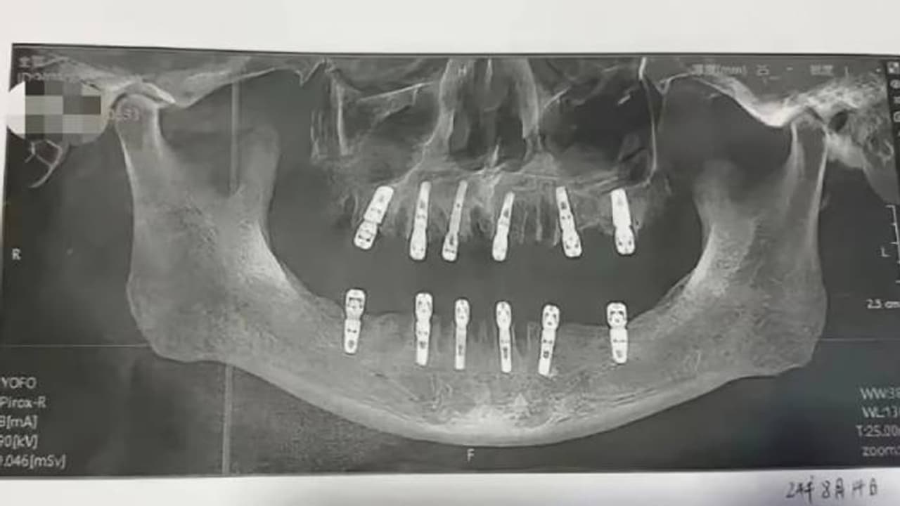 ഒറ്റദിവസം പറിച്ചത് 23 പല്ലുകൾ, 12 വെപ്പുപല്ലുകളും വച്ചു, 13 ദിവസങ്ങൾക്ക് ശേഷം ദാരുണാന്ത്യം