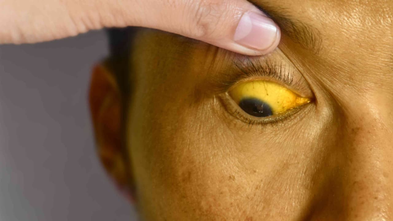 കുറ്റിപ്പുറം മേഖലയിൽ മഞ്ഞപ്പിത്തം പടരുന്നു, നൂറോളം പേർക്ക് സ്ഥിരീകരിച്ചു; കർശന നിർദേശങ്ങളുമായി ആരോഗ്യ വകുപ്പ് കുറ്റിപ്പുറം മേഖലയിൽ മഞ്ഞപ്പിത്തം പടരുന്നു, നൂറോളം പേർക്ക് സ്ഥിരീകരിച്ചു; കർശന നിർദേശങ്ങളുമായി ആരോഗ്യ വകുപ്പ്