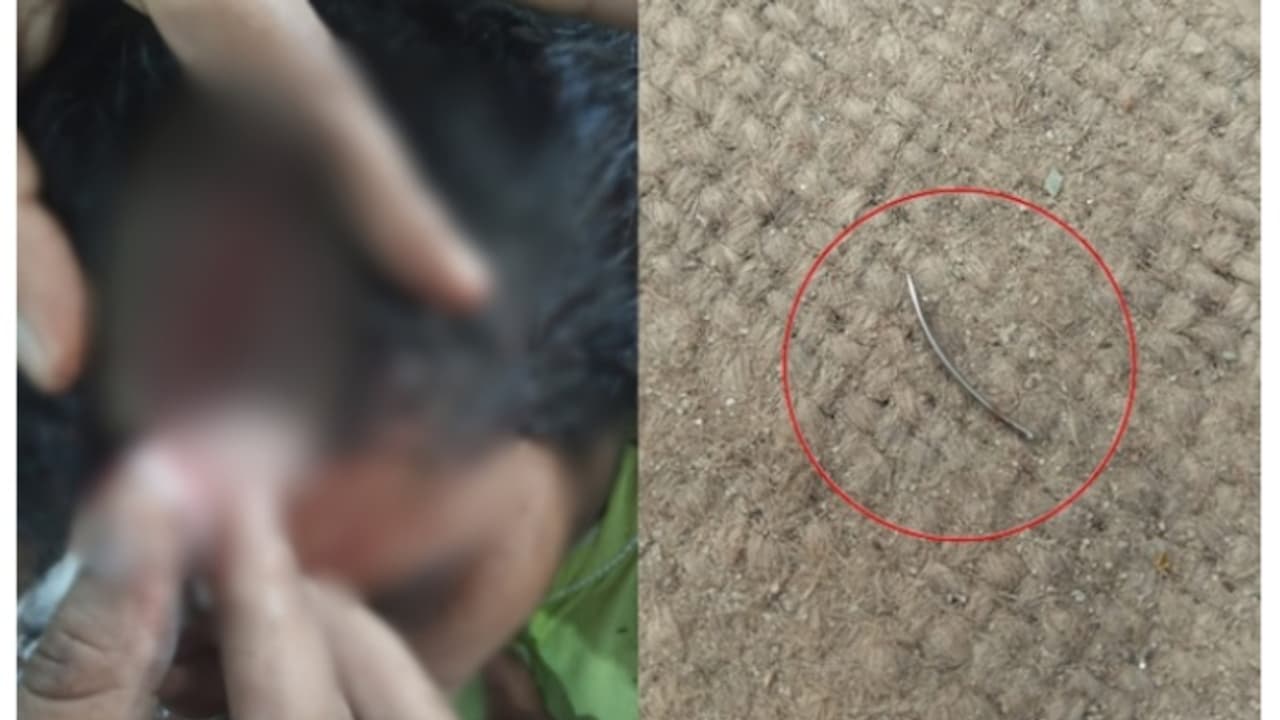 തലയിലെ മുറിവുമായി യുപിയിലെ ആശുപത്രിയിൽ ചികിത്സതേടിയ യുവതിയുടെ ശരീരത്തിൽ ഡോക്ടർ സൂചി മറന്നുവെച്ചെന്ന് ആരോപണം തലയിലെ മുറിവുമായി യുപിയിലെ ആശുപത്രിയിൽ ചികിത്സതേടിയ യുവതിയുടെ ശരീരത്തിൽ ഡോക്ടർ സൂചി മറന്നുവെച്ചെന്ന് ആരോപണം