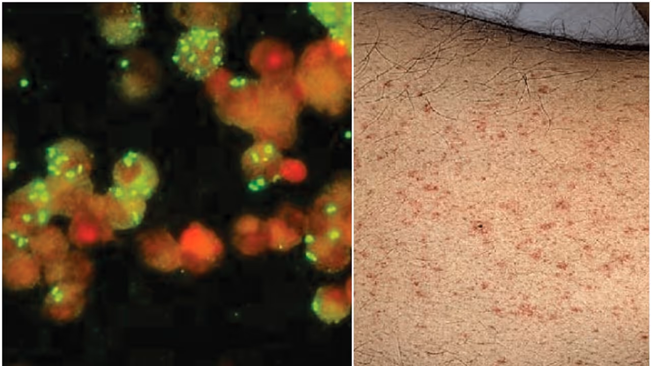 തിരുവനന്തപുരത്ത് മ്യൂറിൻ ടൈഫസ് സ്ഥിരീകരിച്ചു, വിദേശത്ത് നിന്നെത്തിയ ആൾക്ക് രോഗം 