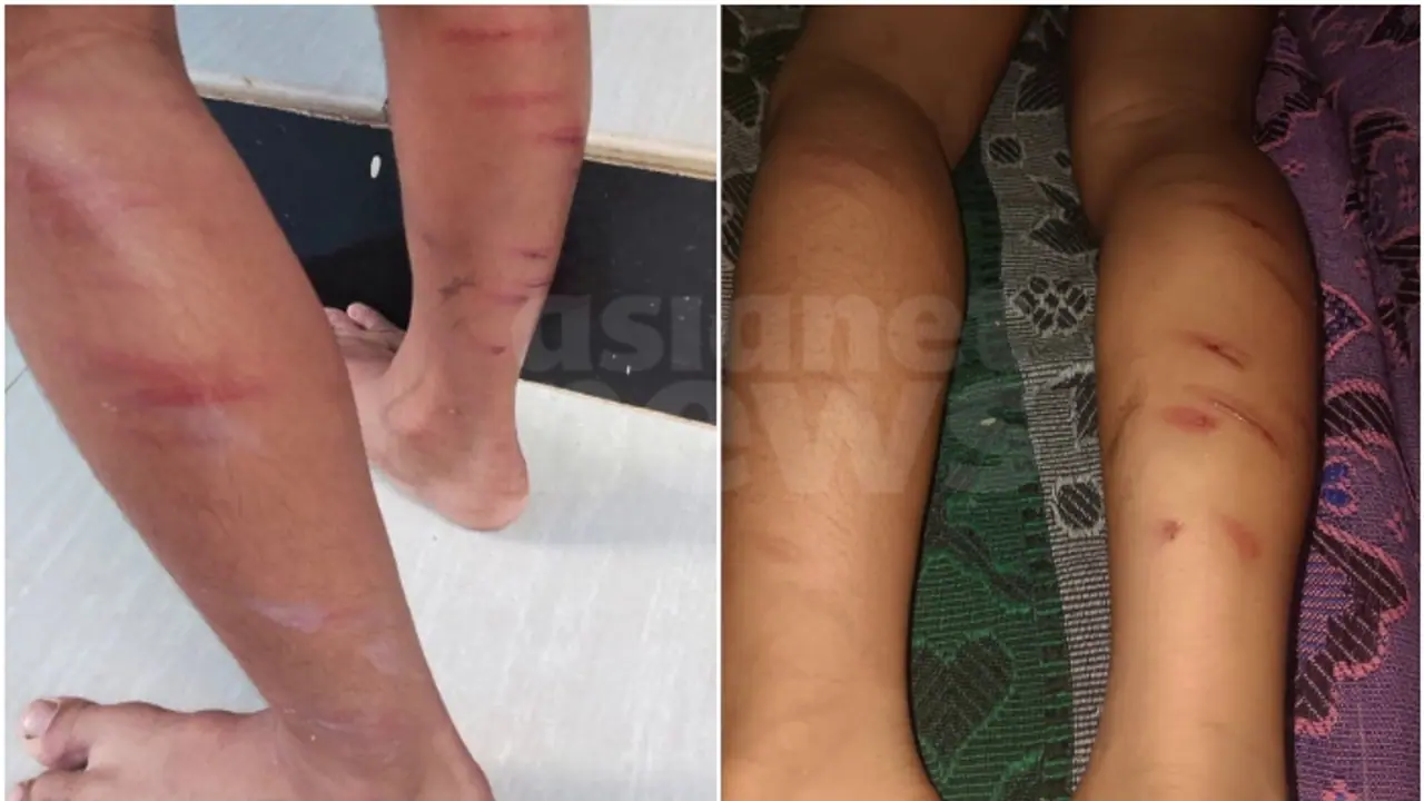 Kerala: 5 year old student brutally caned at Thrissur school; teacher booked 