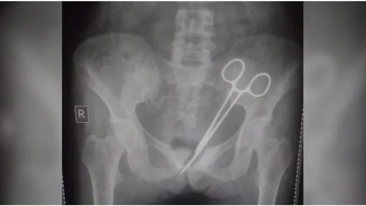 12 വർഷം അലട്ടിയ വയറ് വേദന, പല ഡോക്ടർമാരെയും കണ്ടിട്ടും കാര്യമുണ്ടായില്ല; ഒടുവിൽ കാരണം കണ്ടെത്തിയപ്പോൾ ഞെട്ടൽ