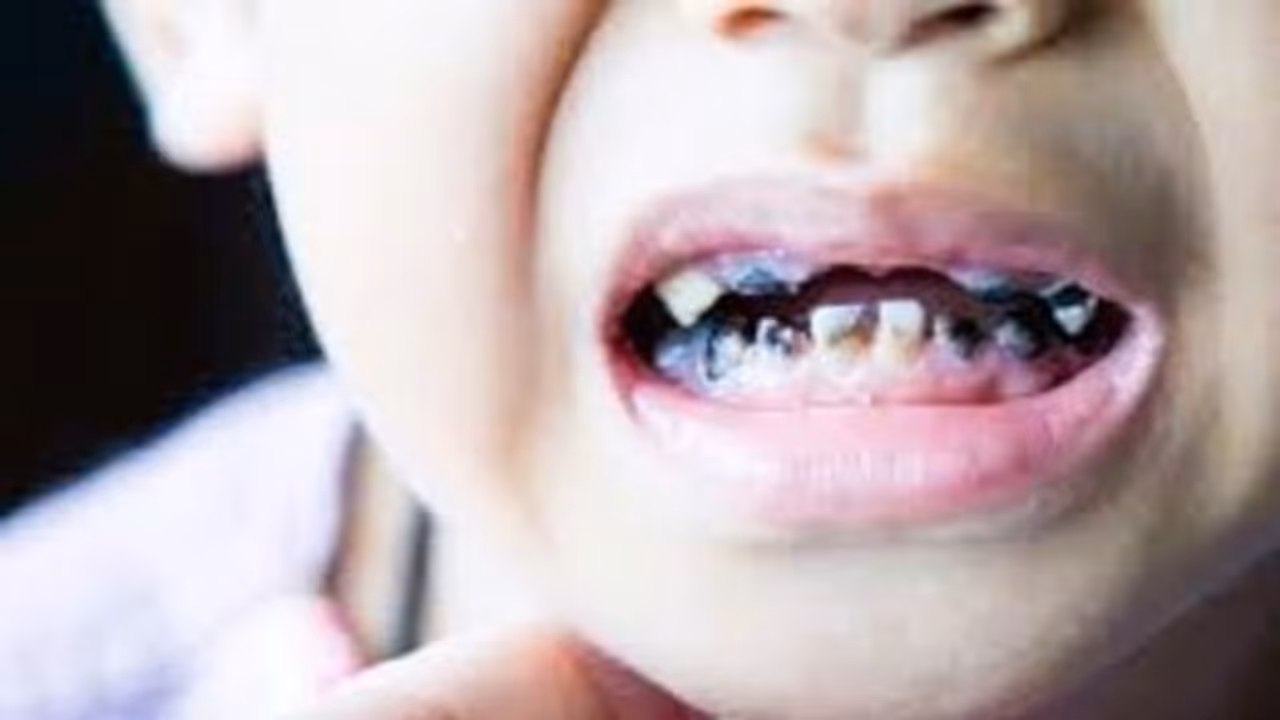 ಹುಳು ಹಿಡಿದ ಹಲ್ಲು ಸರಿಯಾಗ್ಬೇಕಾ? ಇದೊಂದು ಪದಾರ್ಥ ಯೂಸ್ ಮಾಡಿ ನೋಡಿ