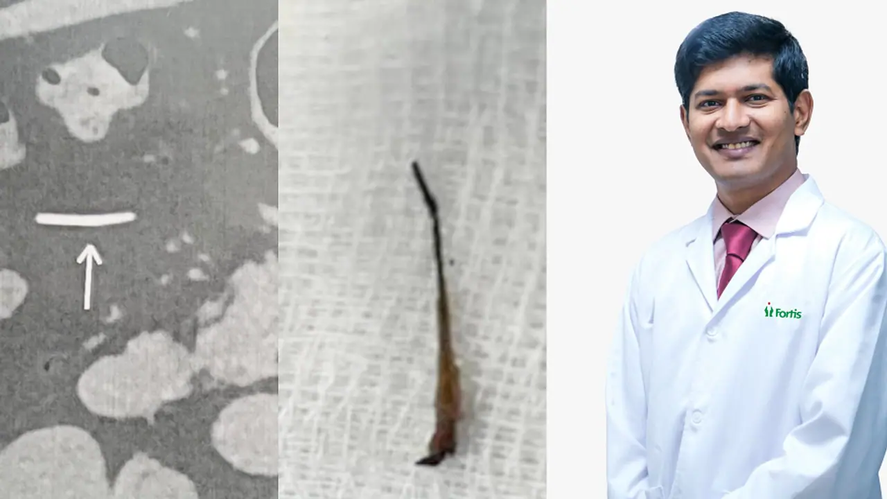 5 ವರ್ಷದಿಂದ ಹೊಟ್ಟೆಯಲ್ಲೇ ಇದ್ದ 2 ಸೆಂ.ಮೀ ಉದ್ದದ ಮೀನಿನ ಮೂಳೆ ಹೊರತೆಗೆದ ಫೋರ್ಟಿಸ್ ವೈದ್ಯರ ತಂಡ! 5 ವರ್ಷದಿಂದ ಹೊಟ್ಟೆಯಲ್ಲೇ ಇದ್ದ 2 ಸೆಂ.ಮೀ ಉದ್ದದ ಮೀನಿನ ಮೂಳೆ ಹೊರತೆಗೆದ ಫೋರ್ಟಿಸ್ ವೈದ್ಯರ ತಂಡ!