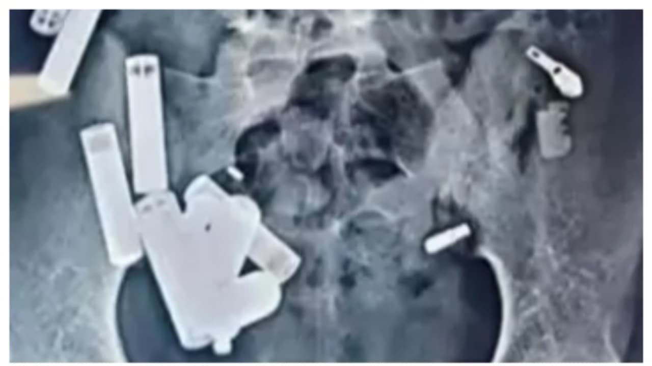 ശ്വാസതടസം, 14 കാരനെ ആശുപത്രിയിലെത്തിച്ചു; സർജറിയിൽ വയറിനുള്ളിൽ കണ്ടെത്തിയത് ബാറ്ററി മുതല് 65 വസ്തുക്കള് ശ്വാസതടസം, 14 കാരനെ ആശുപത്രിയിലെത്തിച്ചു; സർജറിയിൽ വയറിനുള്ളിൽ കണ്ടെത്തിയത് ബാറ്ററി മുതല് 65 വസ്തുക്കള്