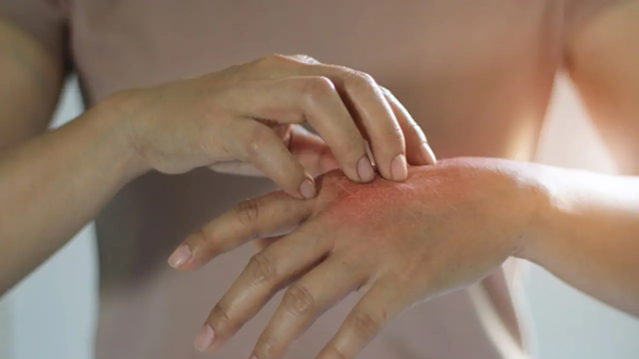 കൊതുക് കടി മൂലമുണ്ടാകുന്ന അസ്വസ്ഥത അകറ്റാന്‍ ഇതാ ചില എളുപ്പ വഴികള്‍ 