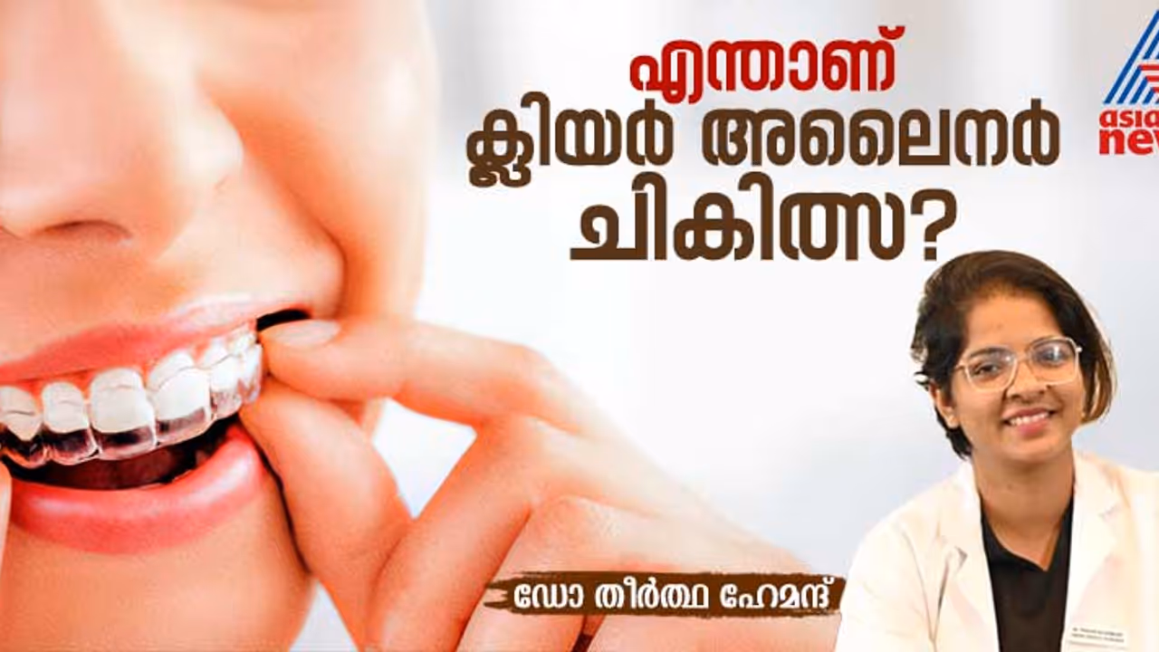 ഇനി പല്ലില് കമ്പി ഇടേണ്ട ; അലൈനര് ചികിത്സ രീതിയെ കുറിച്ചറിയാം ഇനി പല്ലില് കമ്പി ഇടേണ്ട ; അലൈനര് ചികിത്സ രീതിയെ കുറിച്ചറിയാം